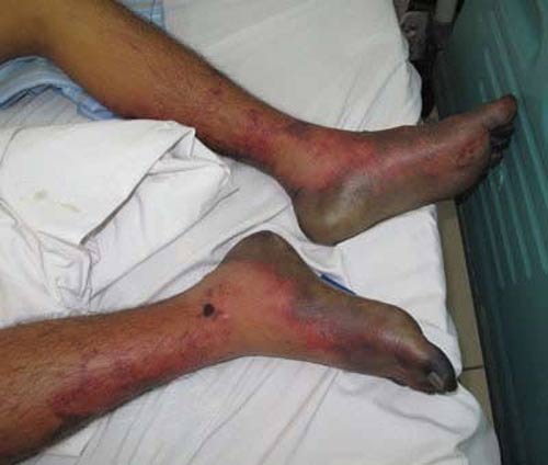 Món chạo làm từ xương, thịt lợn sống: Dễ viêm não - 2