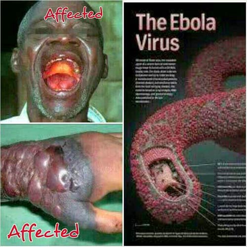 Bệnh do virus Ebola nguy hiểm như thế nào? - 1