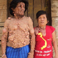 Sức khỏe đời sống - Bệnh lạ khiến ba cha con mang hình hài "quái nhân"