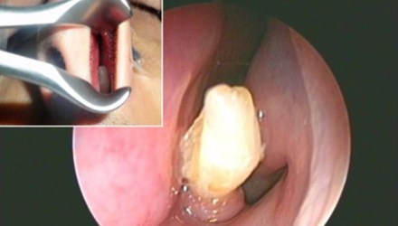 Sửng sốt phát hiện răng mọc… trong mũi - 1
