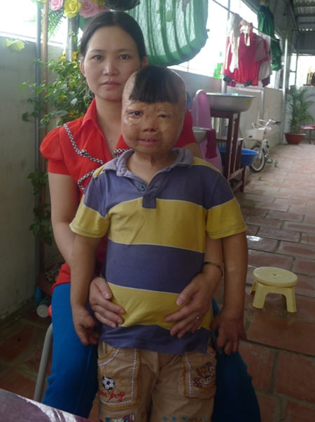 Nghẹn lòng cuộc sống cháu bé bị bố đốt 3 năm trước - 12