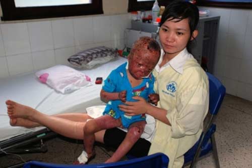 Nghẹn lòng cuộc sống cháu bé bị bố đốt 3 năm trước - 2
