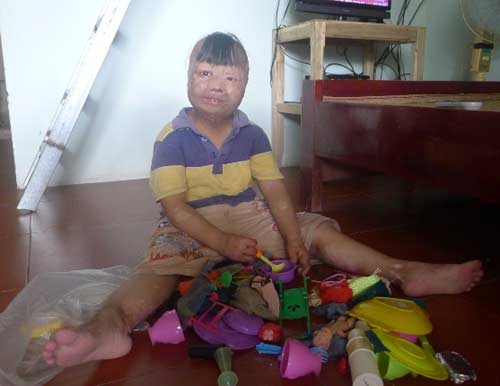 Nghẹn lòng cuộc sống cháu bé bị bố đốt 3 năm trước - 4