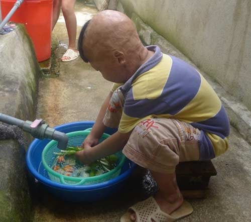 Nghẹn lòng cuộc sống cháu bé bị bố đốt 3 năm trước - 5