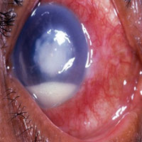 Sức khỏe đời sống - Thiếu nữ mang sẹo trong mắt vì kính áp tròng