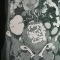 Tin tức trong ngày - Ấn Độ: Bào thai nằm suốt 36 năm trong bụng mẹ