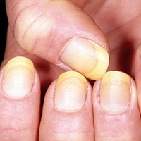 Sức khỏe đời sống - Móng tay hơi ngả vàng: Bệnh gì?