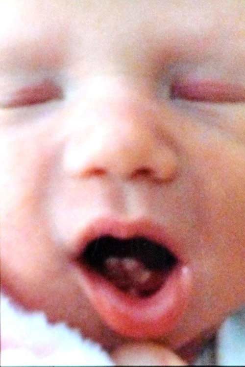 Anh: Bé gái sinh ra đã có 2 răng cửa - 2