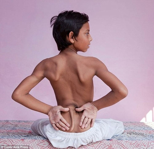 Cắt bỏ đuôi khổng lồ cho bé trai 5 ngày tuổi - 2