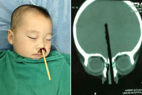 TQ: Bé trai 2 tuổi bị đũa chọc từ mũi lên não - 1
