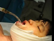 Sức khỏe đời sống - Đại phẫu bóc khối u quái trên gương mặt 2 cô gái