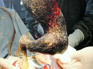 Sức khỏe đời sống - Phẫu thuật lấy 4 kg tóc từ dạ dày thiếu nữ