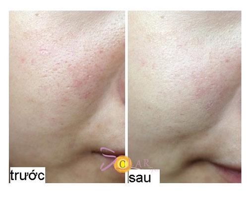 Thu hẹp lỗ chân lông và trắng da mặt hoàn hảo - 4