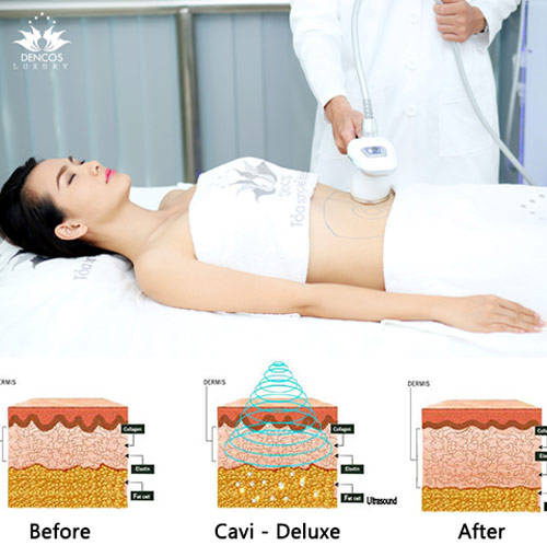 Loại bỏ mỡ thừa, chảy xệ và rạn bụng trong cùng 1 liệu pháp - 3