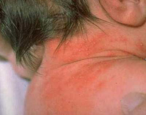 Lưu ý khi chăm sóc và điều trị cho bé bị rôm sảy tại nhà - 1