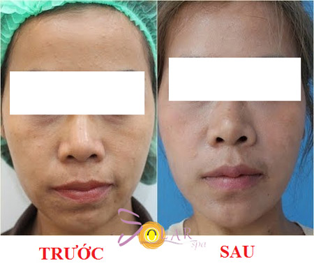 Ưu đãi 70% công nghệ Ultherapy trẻ hóa da 1 lần duy nhất - 2