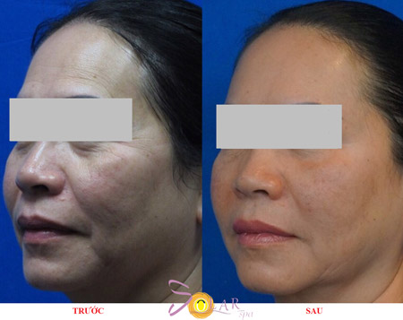Ưu đãi 70% công nghệ Ultherapy trẻ hóa da 1 lần duy nhất - 3