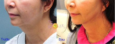 Ưu đãi 70% công nghệ Ultherapy trẻ hóa da 1 lần duy nhất - 4