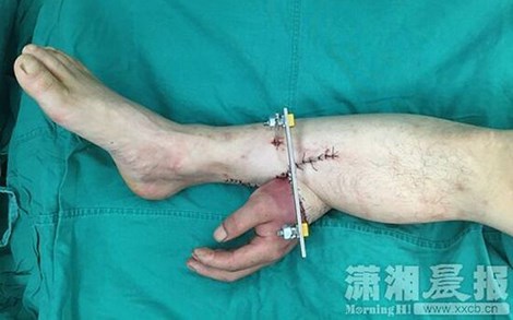 Hi hữu: Phẫu thuật nối tay vào chân - 1
