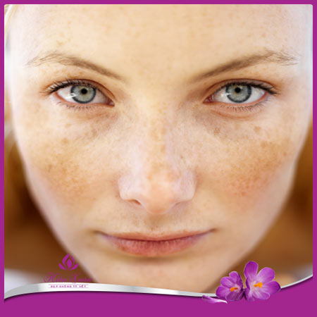 Trị tận gốc nám da do lão hóa bằng thảo dược - 1