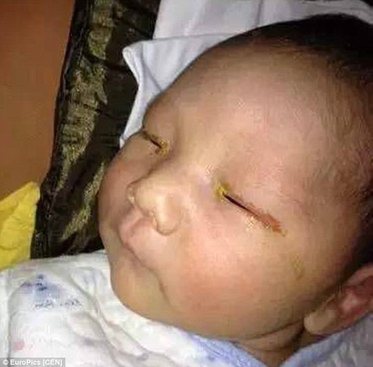 Em bé bị mù một mắt vì chụp hình quên tắt đèn flash - 1