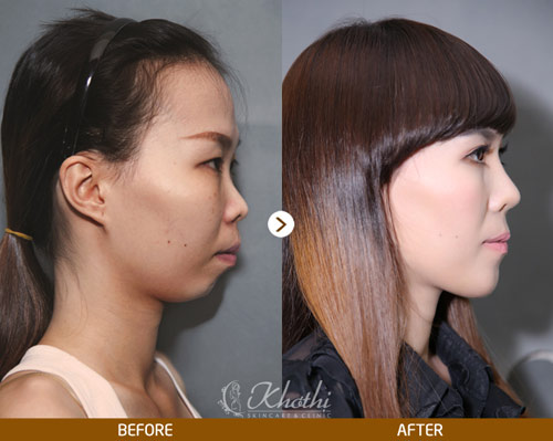 Viện thẩm mỹ Khơ Thị ưu đãi sốc 50% trong tháng 8 - 2