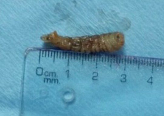 Phẫu thuật gắp bỏ con giun dài 12 cm trong mí mắt - 1