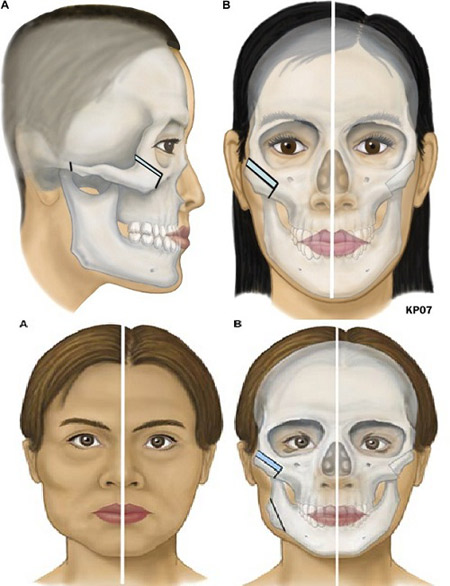 Xóa bỏ gò má “sát phu” nhờ công nghệ L shaflt - 2