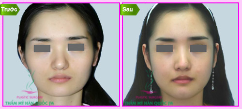 Xóa bỏ gò má “sát phu” nhờ công nghệ L shaflt - 3