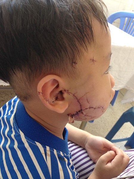 Hàng loạt trẻ nhập viện vì chó cắn - 2