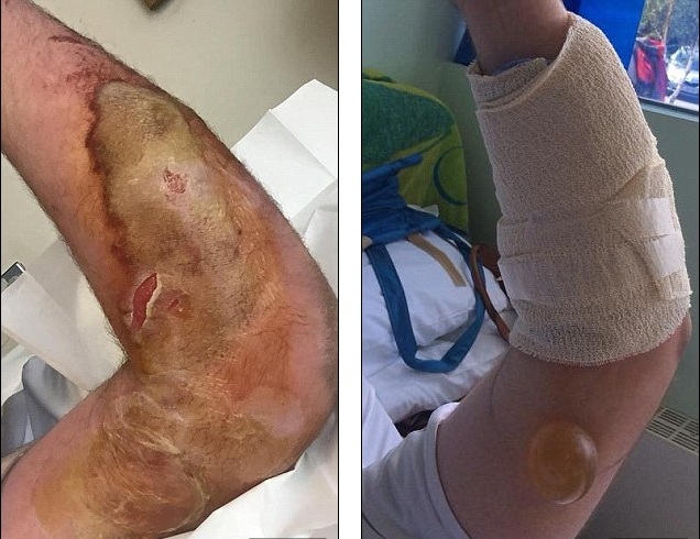 Chàng trai bị bỏng tay nghiêm trọng vì nhện độc cắn - 1