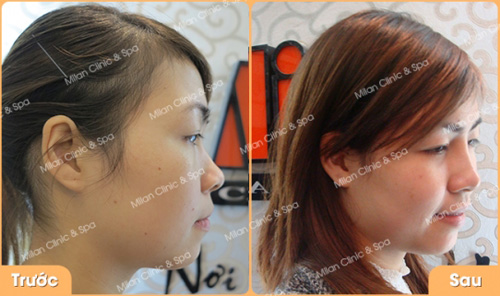 Đừng vội nâng mũi không phẫu thuật nếu như bạn chưa đọc bài viết này - 1