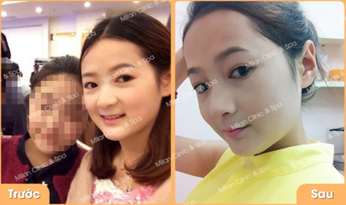 Đừng vội nâng mũi không phẫu thuật nếu như bạn chưa đọc bài viết này - 2