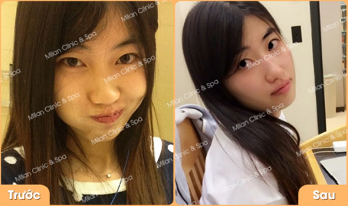 Đừng vội nâng mũi không phẫu thuật nếu như bạn chưa đọc bài viết này - 3