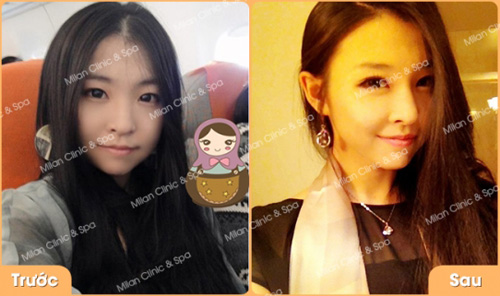 Đừng vội nâng mũi không phẫu thuật nếu như bạn chưa đọc bài viết này - 4