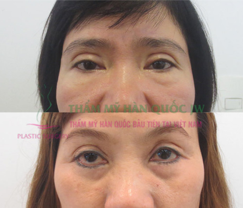 Sửa chữa lại những đôi mắt hỏng do thẩm mỹ sai cách - 2