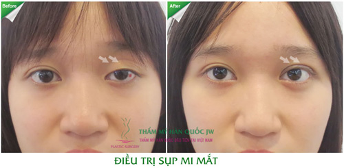 Sửa chữa lại những đôi mắt hỏng do thẩm mỹ sai cách - 5