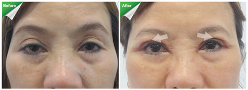 Sửa chữa lại những đôi mắt hỏng do thẩm mỹ sai cách - 6