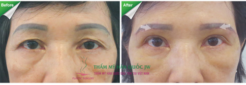 Sửa chữa lại những đôi mắt hỏng do thẩm mỹ sai cách - 7