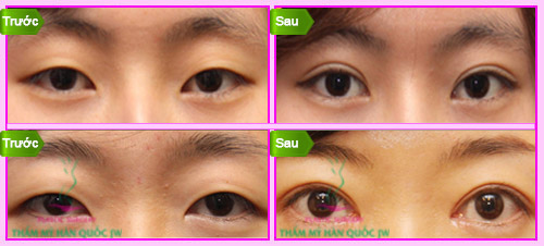 Hiểu đúng về bấm mí – Tiền đề quan trọng để sở hữu đôi mắt đẹp tự nhiên - 6