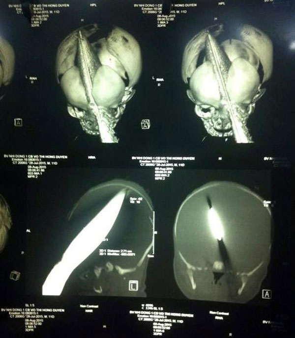 20 ngày vượt ải sinh tử của bé trai bị dao đâm xuyên đầu - 2