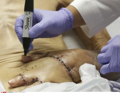 Ủ bàn tay bị bỏng trong ổ bụng để tránh đoạn chi - 2