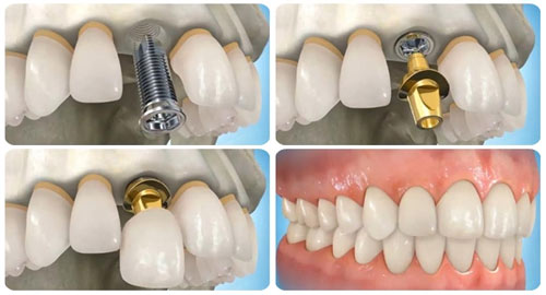 Trồng răng giả nguyên hàm bằng cách cấy ghép Implant - 1