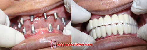 Trồng răng giả nguyên hàm bằng cách cấy ghép Implant - 2