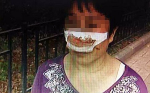 Trung Quốc: Cắn đứt mũi vợ do không nghe điện thoại - 1