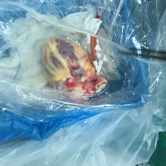 Quả tim sau khi phẫu thuật lập tức được bảo quản trong dung dịch đặc biệt và cho một túi nilon sau đó bỏ vào thùng đá
