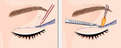 Phụ nữ 30+ và nỗi buồn mắt sụp mí - 3