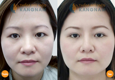 Phụ nữ 30+ và nỗi buồn mắt sụp mí - 5