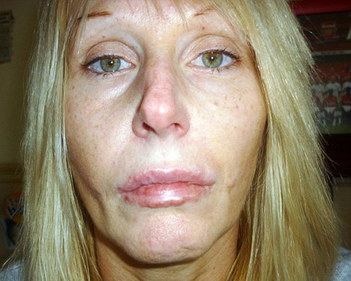 Chị em thi nhau bơm, rạch để có môi trái tim quyến rũ - 3