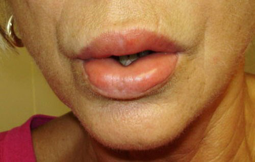 Chị em thi nhau bơm, rạch để có môi trái tim quyến rũ - 5